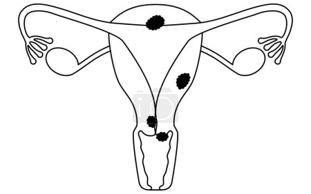 Ilustración diagramática del cáncer de cuello uterino, anatomía del útero y ovarios, ilustración vectorial