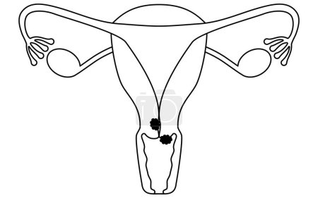 Diagrammatic illustration of cervical cancer, anatomy of the uterus and ovaries, Vector Illustration