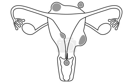Diagrammatische Darstellung der Myome der Gebärmutter, Anatomie der Gebärmutter und der Eierstöcke, Vektorillustration