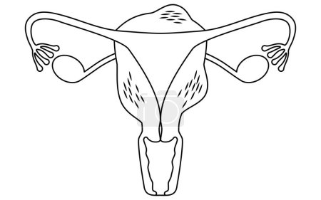 Diagrammatic illustration of adenomyosis, anatomy of the uterus and ovaries, Vector Illustration