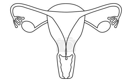 Ilustración diagramática de pólipos cervicales, anatomía del útero y ovarios, ilustración vectorial