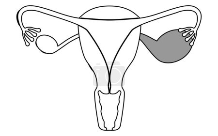 Illustration schématique de l'endométriose, anatomie de l'utérus et des ovaires, Illustration vectorielle