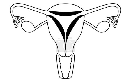 Diagrammatische Darstellung der endometrischen Hyperplasie, Anatomie der Gebärmutter und der Eierstöcke, Vektorillustration