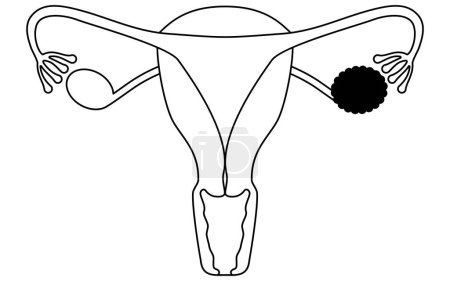 Diagrammatic illustration of ovarian cysts, anatomy of the uterus and ovaries, Vector Illustration