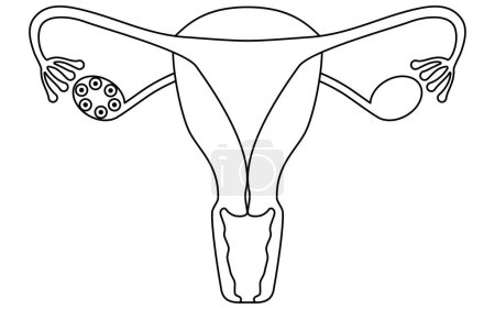 Diagrammatische Darstellung des polyzystischen Ovar-Syndroms (Ovulationsstörung), der Anatomie der Gebärmutter und der Eierstöcke - Übersetzung: Ovulationsversagen Gelingt der Eisprung nicht, bleibt die Eizelle im Ovar.