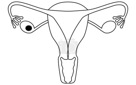 Diagrammatic illustration of stage I ovarian cancer, anatomy of the uterus and ovaries, anatomy of the uterus and ovaries - Translation: Cancer is confined to the ovaries or fallopian tubes