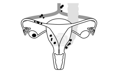 Ilustración diagramática del cáncer de ovario en estadio III, la anatomía del útero y los ovarios, la anatomía del útero y los ovarios. Traducción: El cáncer se diseminó a los ganglios linfáticos o a través de la cavidad pélvica hasta el peritoneo, el mesenterio grande o el i pequeño.