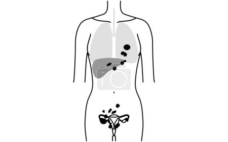 Diagrammatische Darstellung von Eierstockkrebs im Stadium IV, Anatomie der Gebärmutter und der Eierstöcke, Anatomie der Gebärmutter und der Eierstöcke - Übersetzung: Krebs hat sich auf Leber, Lunge usw. ausgebreitet.