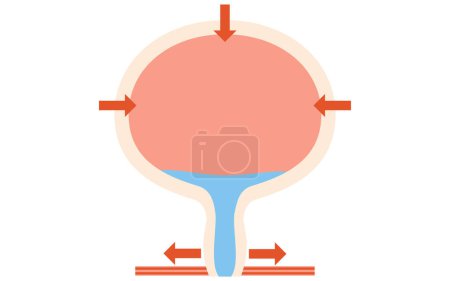Medical illustration of the normal bladder, how it urinates, and how it urinates, Vector Illustration
