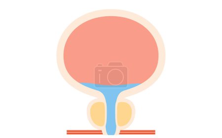 Ilustración médica de hiperplasia prostática benigna, próstata normal, ilustración vectorial