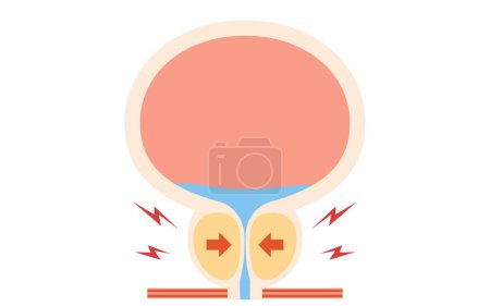 Ilustración médica de hiperplasia prostática benigna, próstata agrandada, ilustración vectorial