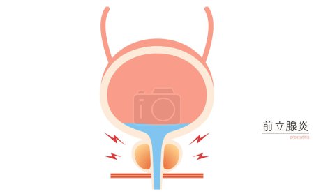 Ilustración médica de próstata, prostatitis, ilustración vectorial