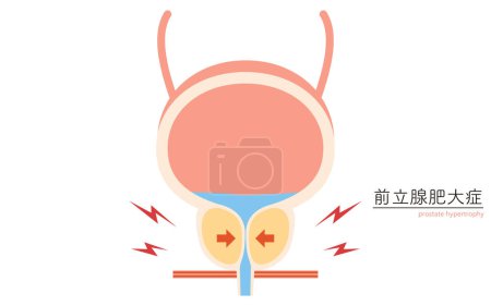 Ilustración médica de hiperplasia prostática benigna, próstata normal vs. agrandada, ilustración vectorial