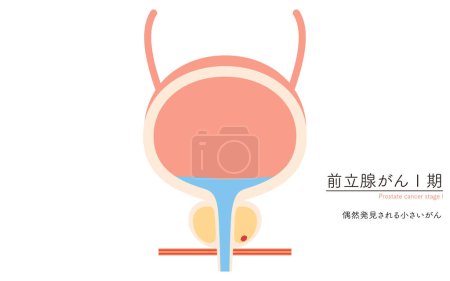 Medical Illustration of Prostate, Stage 1 Prostate Cancer - Translation: Small cancers discovered by chance