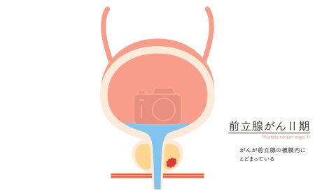 Medizinische Illustration von Prostatakrebs im Stadium 2 - Übersetzung: Krebs ist auf die Prostatakapsel beschränkt