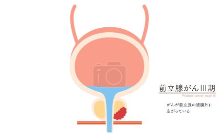 Ilustración médica del cáncer de próstata en estadio 3 - Traducción: El cáncer se diseminó fuera de la cápsula de próstata.