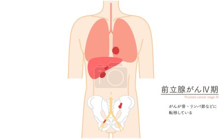 Ilustración médica del cáncer de próstata en estadio 4 - Traducción: El cáncer se ha metastatizado a hueso, ganglios linfáticos, etc..