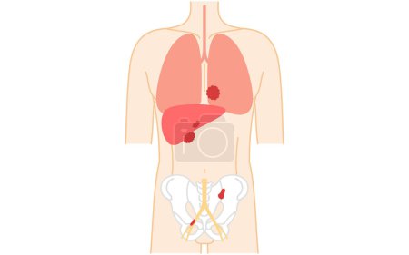 Ilustración médica del cáncer de próstata en estadio 4, ilustración vectorial