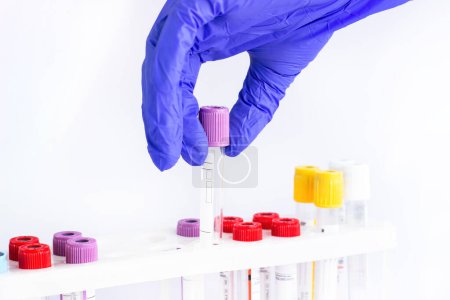 hands of a laboratory assistant with a blood sample and fortitude with blood samples . laboratory assistant holding a blood sample for research