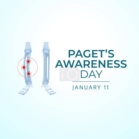 Illustration for Flyers honoring Paget's Awareness Day or promoting associated events might include vector pictures concerning the day. design of flyers, celebratory materials. - Royalty Free Image