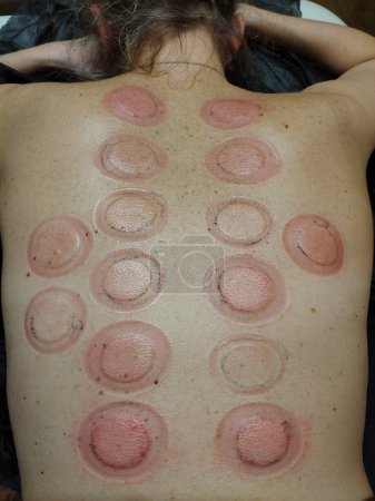 Foto de A woman's back with rows of round red spots from treatment with unconventional medical methods - Imagen libre de derechos