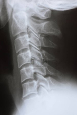 Téléchargez les photos : Close-up lateral X-ray of the neck and cervical spine of a person - en image libre de droit
