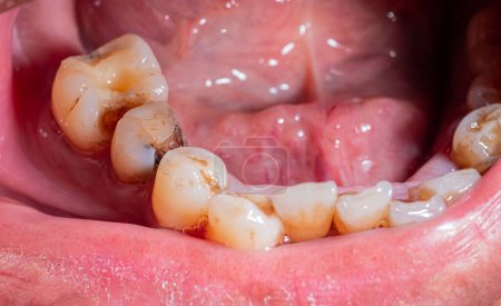 Karies, kaputte Zähne, Mundgesundheit Schlechte Zahngesundheit. Mundgesundheit. Lockere, gelbe Zähne, Zahnbelag und Zahnstein am Zahnfleischrand