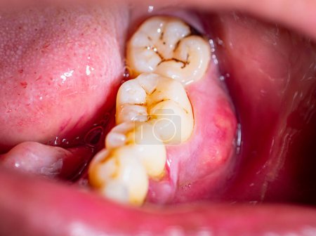 Photo for Poor oral and dental health, cavities, gum disease and swollen gums can lead to toothache. The teeth are stained black, dirty from plux and yellow. - Royalty Free Image