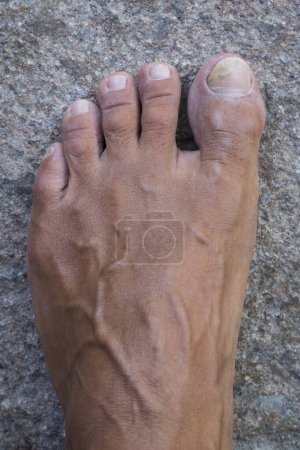 Photo for Toenails with fungus problems,Onychomycosis, also known as tinea unguium, is a fungal infection of the nail, stone background. - Royalty Free Image