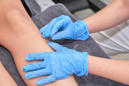 Photo for Close-up of shirtless man receiving dry needling therapy from physician in clinic Close-up of physiotherapist performing dry needling treatment on leg. Injury recovery procedure - Royalty Free Image