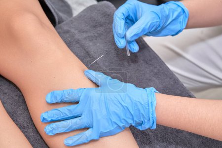 Photo for Close-up of shirtless man receiving dry needling therapy from physician in clinic Close-up of physiotherapist performing dry needling treatment on leg. Injury recovery procedure - Royalty Free Image