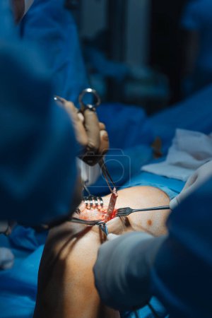 Téléchargez les photos : Gros plan d'un genou humain sectionné sur une table d'opération où une chirurgie de remplacement du genou est pratiquée - en image libre de droit