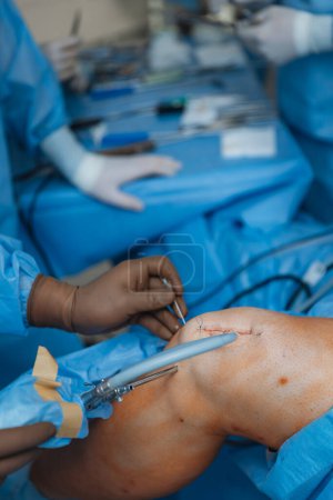 Téléchargez les photos : Gros plan d'un genou humain sectionné sur une table d'opération où une chirurgie de remplacement du genou est pratiquée - en image libre de droit