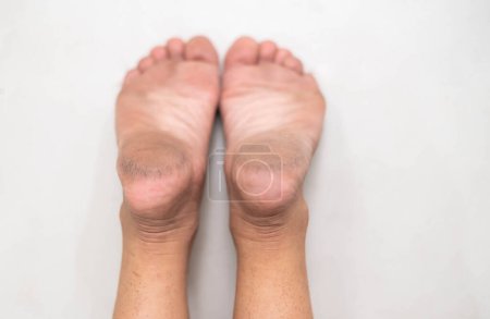 Téléchargez les photos : Pieds avec peau sèche pour montrer sur le pied malsain. Doit être souvent le traitement dans tous les jours. - en image libre de droit