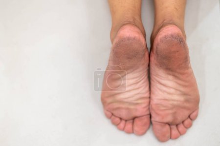 Téléchargez les photos : Pieds avec peau sèche montrent un pied malsain. Doit être souvent traitée tous les jours. - en image libre de droit