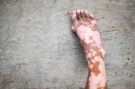 Téléchargez les photos : The old man's leg with a skin condition that causes loss of melanin posing indoors. The foot model in a black tank top suffers from vitiligo disorder. - en image libre de droit
