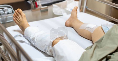 Foto de La paciente anciana muestra sus cicatrices cirugía de la herida quirúrgica de la pierna rota en la cama en enfermería sala de hospital. - Imagen libre de derechos