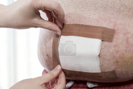 Photo for Detail of nurse's hands dressing the patient's umbilical hernia wound, placing sterile gauze on it after performing disinfection. Focus on the thumbs - Royalty Free Image