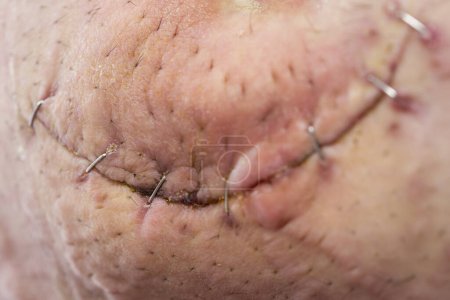 Téléchargez les photos : Détail de l'incision de la hernie ombilicale avec points de suture après la chirurgie. Focus sélectif sur la cicatrice - en image libre de droit