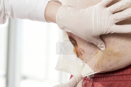 Foto de Detalle de las manos de la enfermera quitando una vieja gasa de la hernia umbilical del paciente, preparándola para la desinfección. Concéntrate en el ombligo - Imagen libre de derechos