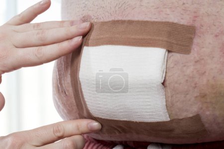 Photo for Detail of nurse's hands dressing the patient's umbilical hernia wound, placing sterile gauze on it after performing disinfection. Selective focus on the gauze - Royalty Free Image