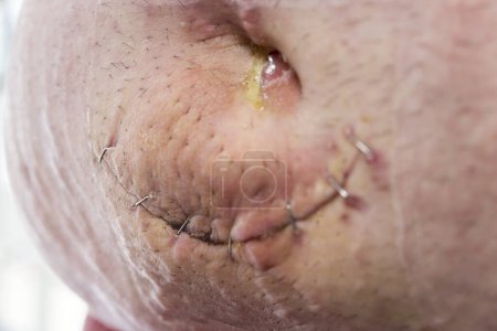 Téléchargez les photos : Détail de l'incision de la hernie ombilicale avec points de suture après la chirurgie. Focus sélectif sur la cicatrice - en image libre de droit