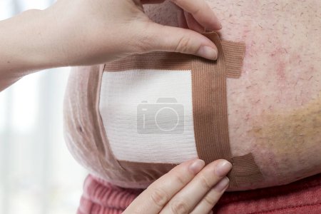 Photo for Detail of nurse's hands dressing the patient's umbilical hernia wound, placing sterile gauze on it after performing disinfection. Selective focus on the lower hand and the gauze - Royalty Free Image