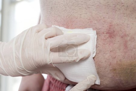 Téléchargez les photos : Gros plan des mains de l'infirmière plaçant de la gaze stérile sur les patients atteints de hernie ombilicale après désinfection. Focus sélectif sur les doigts et la gaze - en image libre de droit