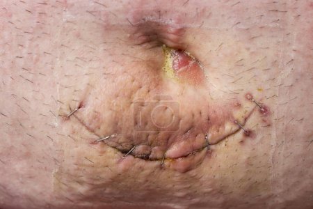 Close up of umbilical hernia wound with stitches after surgery. Selective focus on the navel and the scar