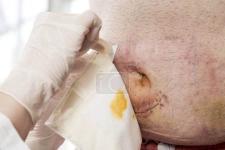 Foto de Detalle de las manos de la enfermera quitando una vieja gasa de la hernia umbilical del paciente, preparándola para la desinfección. Enfoque selectivo en el ombligo - Imagen libre de derechos