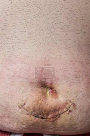 Téléchargez les photos : Gros plan de la plaie de la hernie ombilicale avec des points de suture après la chirurgie. Focus sélectif sur le nombril et la cicatrice - en image libre de droit