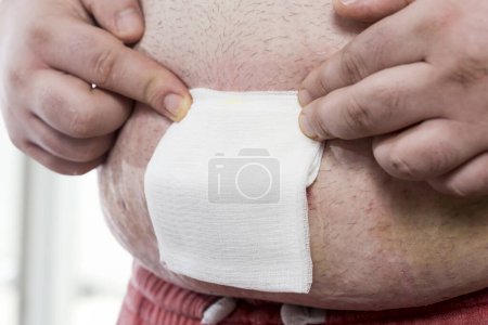 Photo for Detail of patient holding a sterile gauze on his umbilical hernia wound during the wound bandaging. Focus on the fingers of the hand on the right - Royalty Free Image