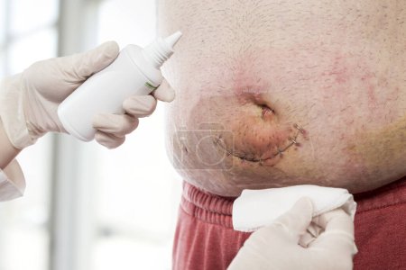 Photo for Detail of nurse's hands dressing the patient's umbilical hernia wound after surgery, disinfecting the skin by rinsing the wound with hydrogene - Royalty Free Image