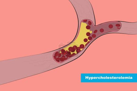Ilustración de La hipercolesterolemia familiar es un trastorno genético. Es causada por un defecto en el cromosoma 19. - Imagen libre de derechos